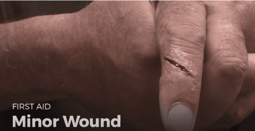 Video: minor wound