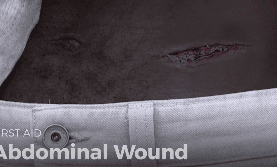 Video: abdominal wound