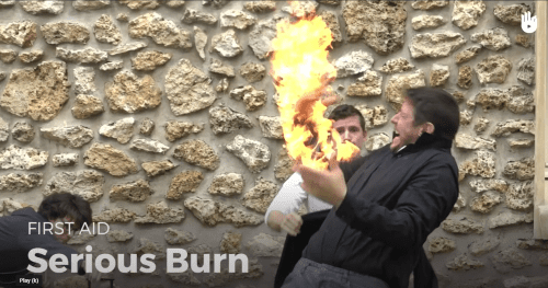 First aid: serious burn