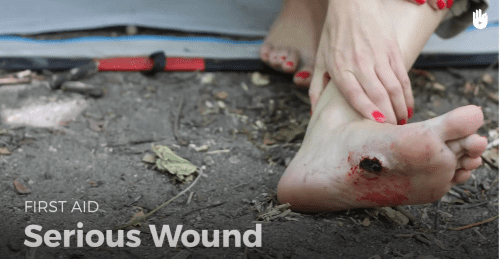 Video: serious wound