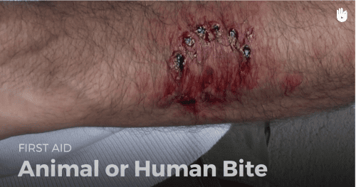 First aid: animal or human bite