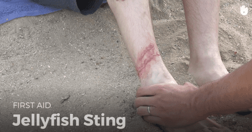 First aid: Jellyfish sting