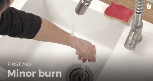 First aid: minor burn